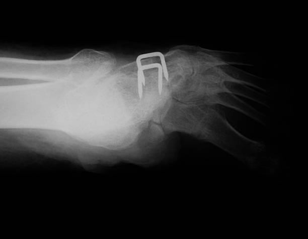 menschlicher fuß x-ray - bending human foot ankle x ray image stock-fotos und bilder