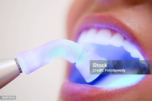 歯科充てん材乾燥 - 歯科衛生のストックフォトや画像を多数ご用意 - 歯科衛生, レーザー光, 歯科用機器