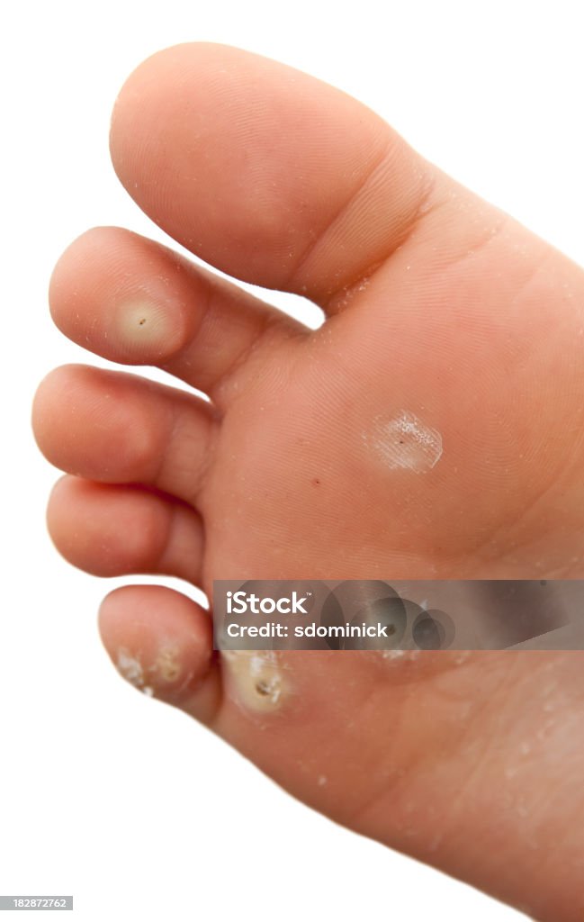 Planters Warts Planters Warts on the bottom of a child's foot. Wart Stock Photo