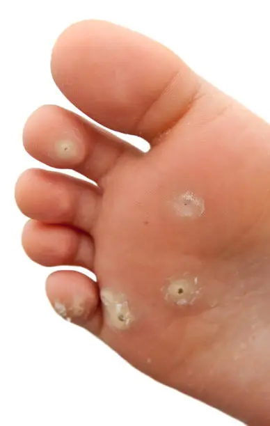 Planters Warts on the bottom of a child's foot.