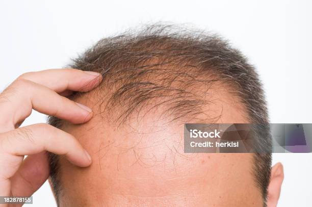 Parcialmente Calvo Foto de stock y más banco de imágenes de Pérdida de pelo - Pérdida de pelo, Parcialmente calvo, Hombres