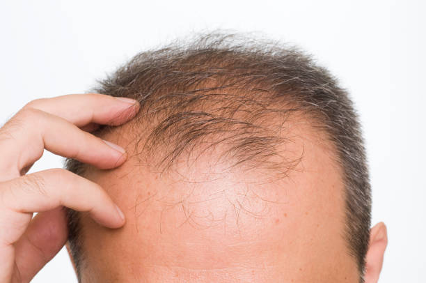 Balding "balding, to become bald" balding stock pictures, royalty-free photos & images