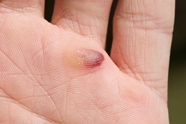 blood blister stock photo