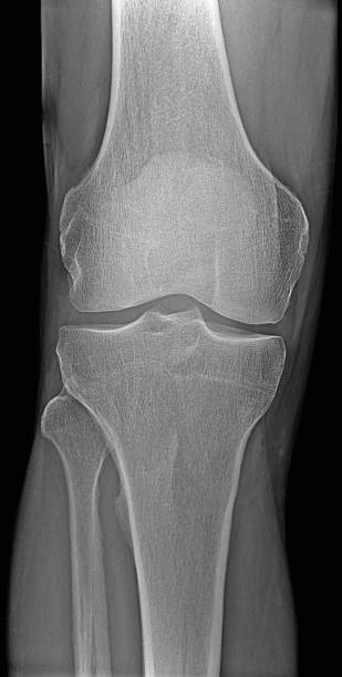 radiografia ginocchio - lateral condyle ストックフォトと画像