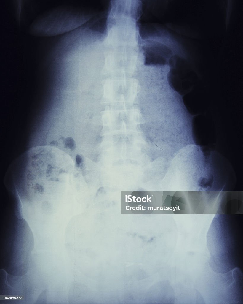 x-ray de bloqueado intestines - Foto de stock de Abdome royalty-free