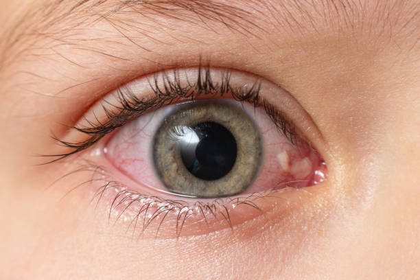 zbliżenie podrażnione zakażone czerwone oczy, zapalenie spojówek - conjunctivitis sore eyes child human eye zdjęcia i obrazy z banku zdjęć