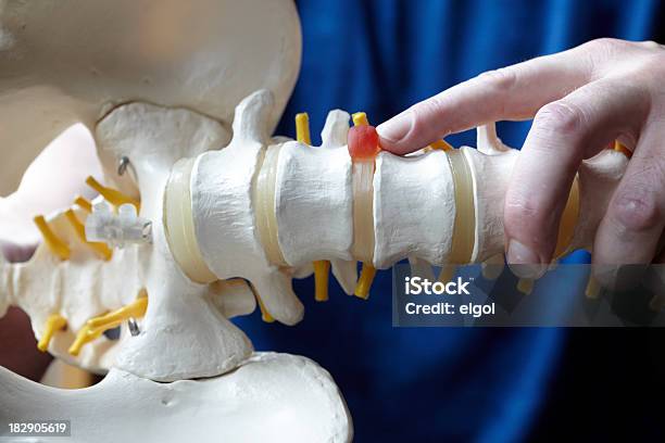 Foto de Médico Apontando Para Prolapsed De Desconto No Modelo De Coluna e mais fotos de stock de Discos intervertebrais