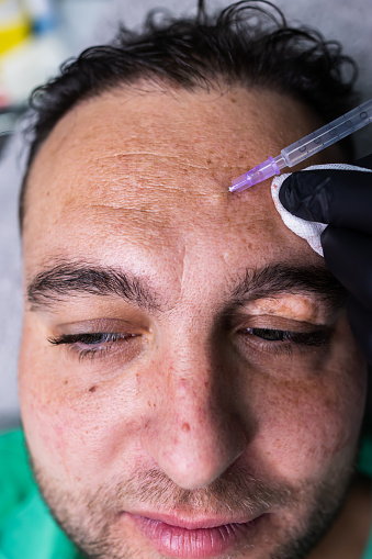 Half-face photo of a middle aged male patient lying on the clinic table while having a rejuvenating hyaluronic acid treatment injected into his forehead.