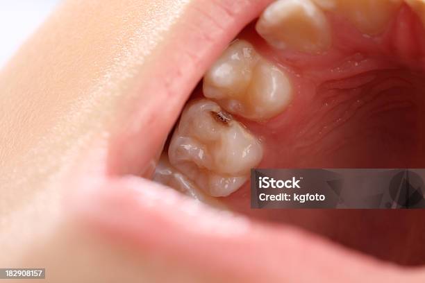 Zahnaussparung Stockfoto und mehr Bilder von Plombe - Plombe, Zahnkaries, Kind