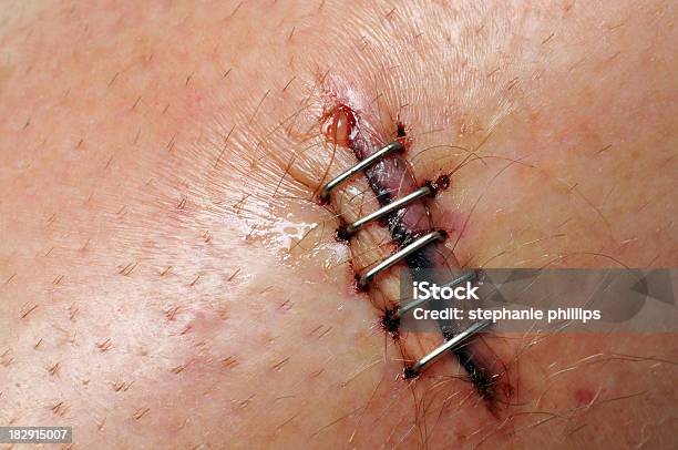 Detail Der Beine Laceration Mit Fünf Basics Stockfoto und mehr Bilder von Makrofotografie - Makrofotografie, Naht - Medizinisches Material, Naht - Saum