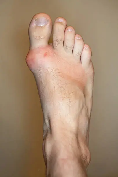 Big toe joint inflamed with gout and small ulceration.