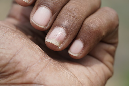 psoriasis on nails , nail damage