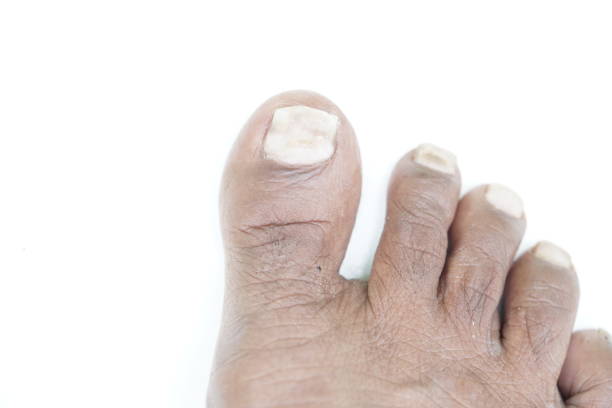 istock Toe nail psoriasis ,close up view 1829521498