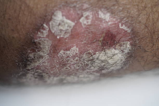 istock psoriasis skin disease on calf muscle 1829524128