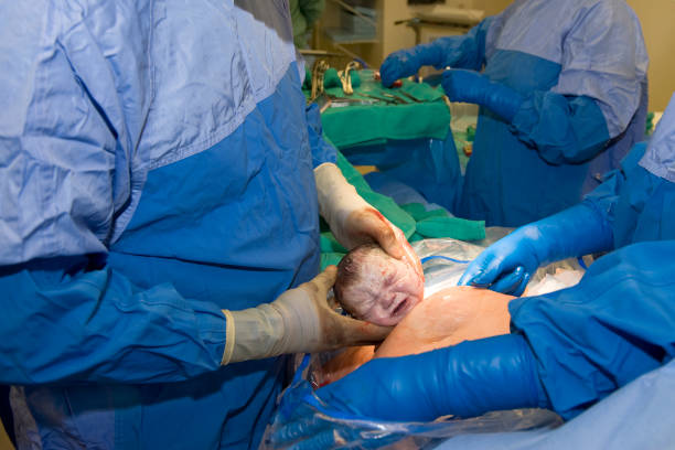 Cesarean Birth - Head and Doctor stock photo