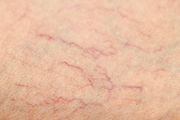 Human Spider Veins on Leg Closeup stock photo