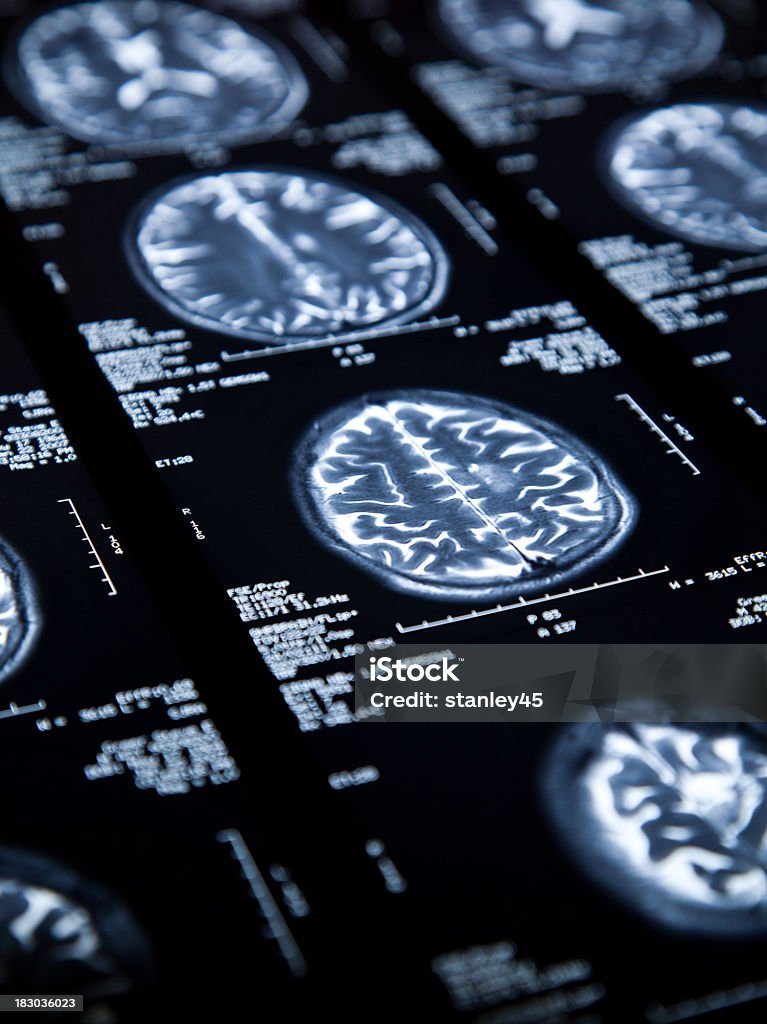 МРТ головного мозга - Стоковые фото Вертикальный роялти-фри