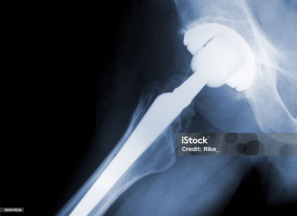 Raggi X della giuntura dell'anca [ Articulatio coxae ] - Foto stock royalty-free di Abbreviazione