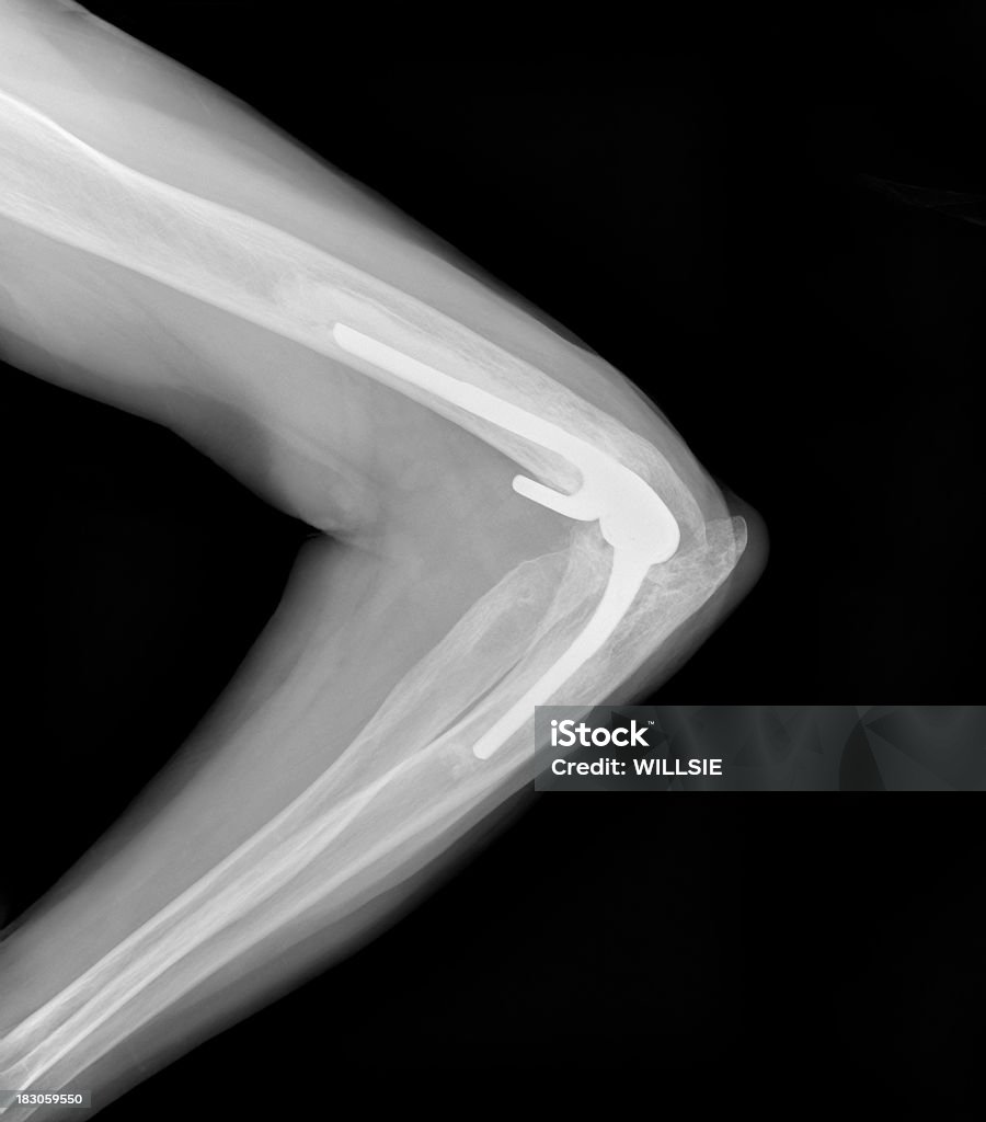 디지탈 X-선 팔의 팔꿈치를 관절 전치환술 후 - 로열티 프리 X-레이 스톡 사진
