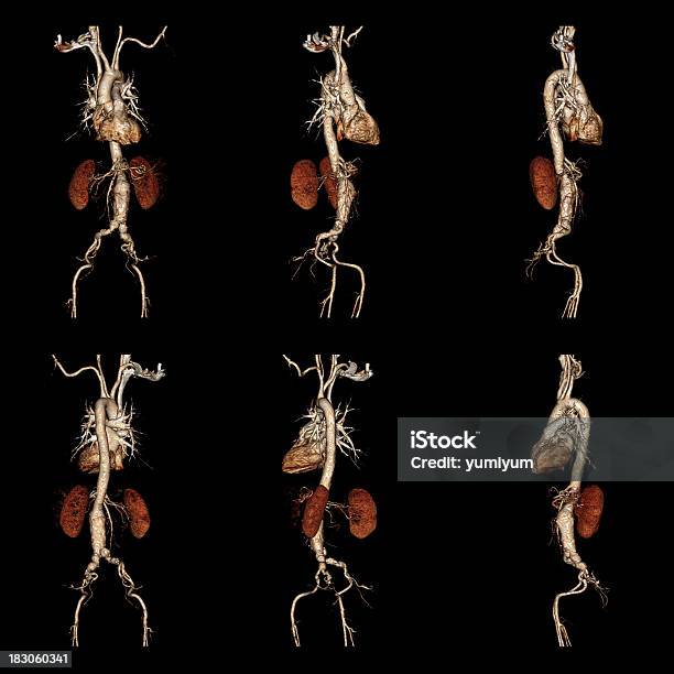 Computerized Tomography Angiogram Stock Photo - Download Image Now - Aneurysm, CAT Scan, Dissection