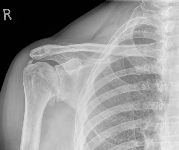 digital ombro xray com graves Osteoartrite - foto de acervo