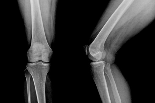 X-ray image of knee