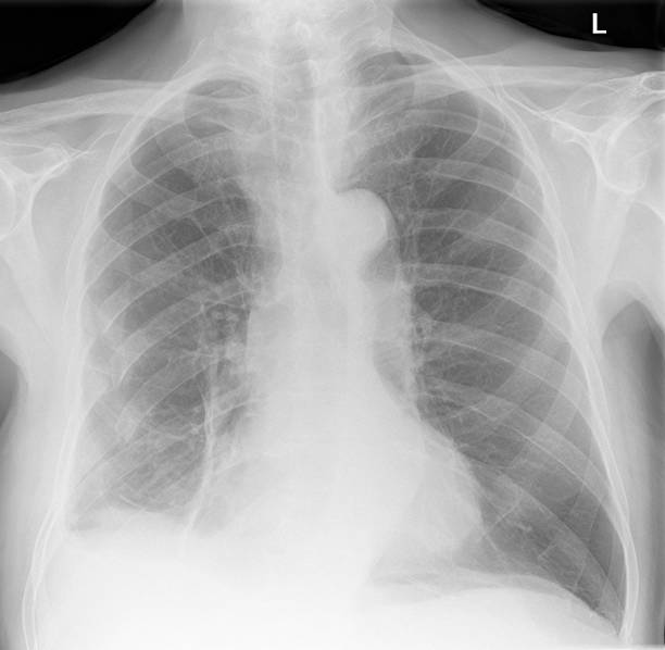 デジタル胸 xray 後の外傷プロークンリブ付き ストックフォト