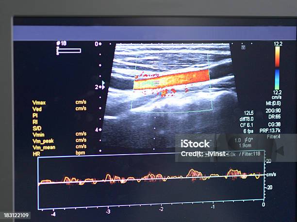 Foto de Terapia Ultrassom e mais fotos de stock de Ultrassom - Ultrassom, Vaso sanguíneo, Exame Médico - Procedimento Médico