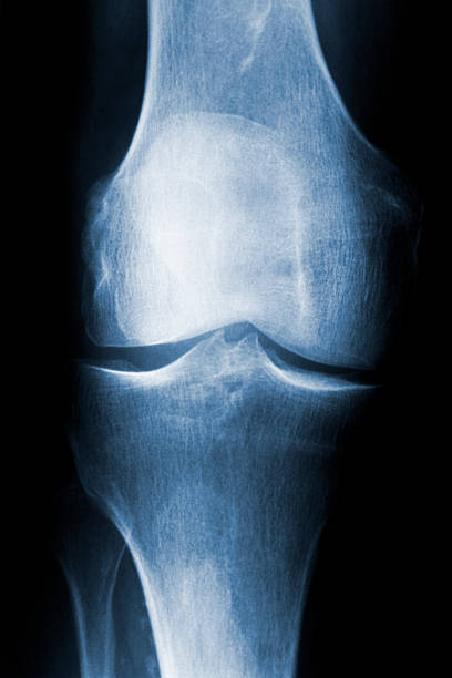 x-ray de genou droit avec arthrose/arthrose im knie - x ray human knee orthopedic equipment human bone photos et images de collection