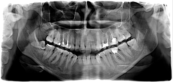 panaramic x-rays of teeth