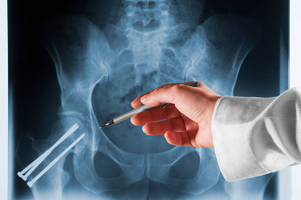 医師ポイントで xray 人間のヒップにメタルのピン - human spine mri scan x ray doctor ストックフォトと画像