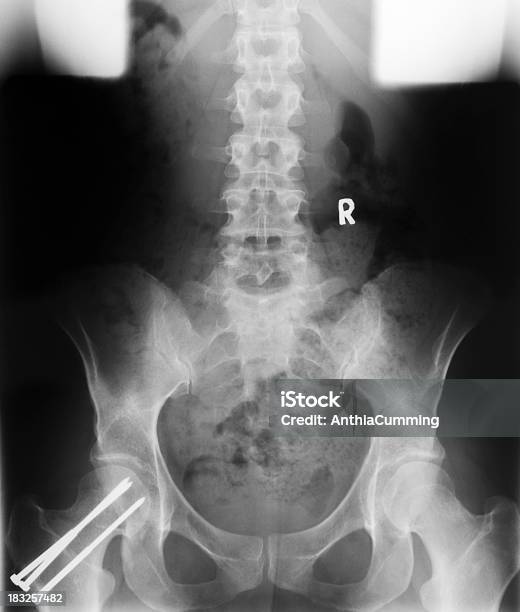 Медицинский Рентген В Области Бедер И Спины Врачам — стоковые фотографии и другие картинки Нижний отдел спины