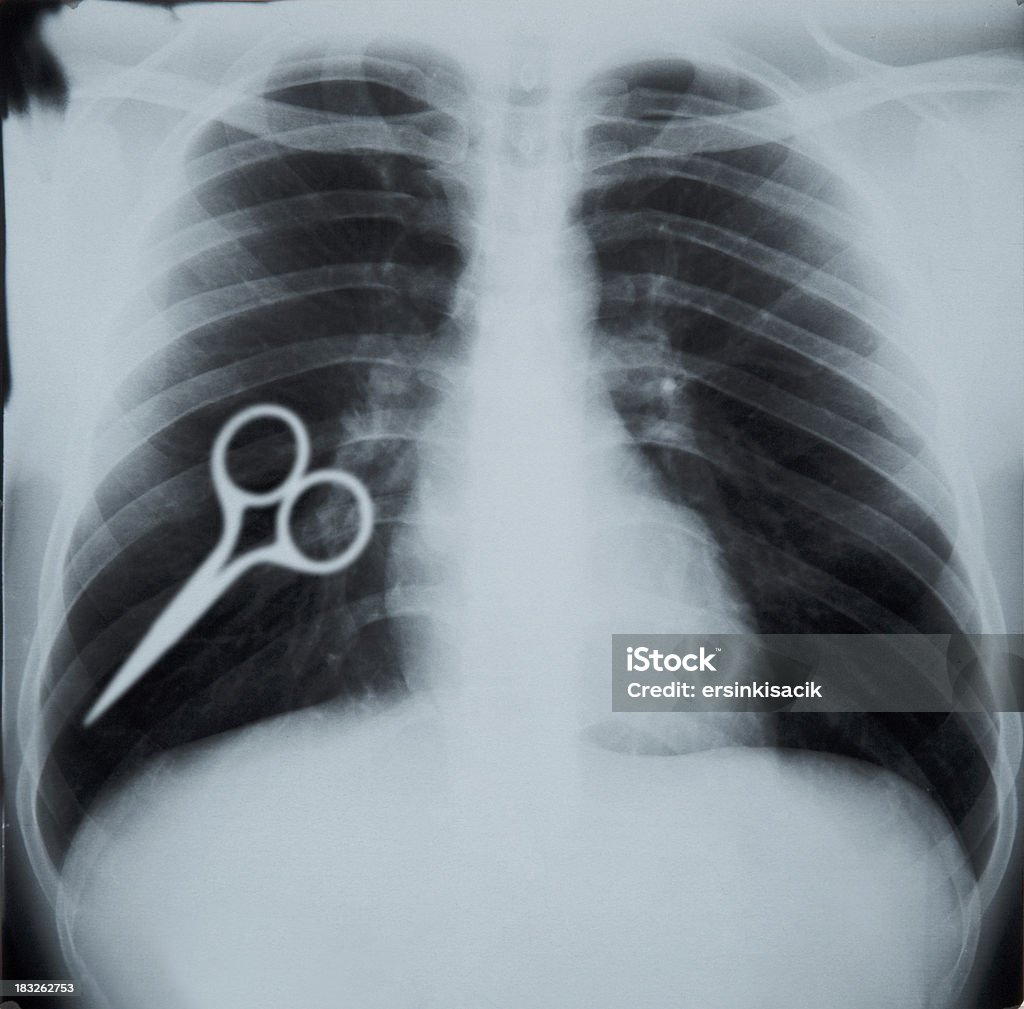 흉부 X-선 및 치중합니다 - 로열티 프리 실패 스톡 사진