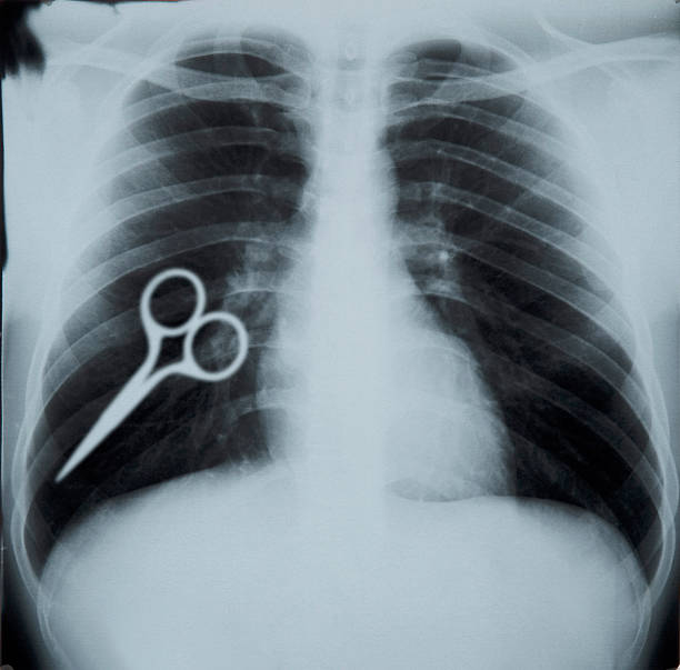 CHEST AND LUNG XRAY stock photo