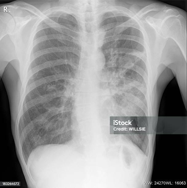 Posición De Tórax Xray Digital Mostrando Una Infección Foto de stock y más banco de imágenes de Imagen de rayos X
