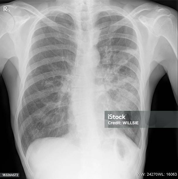 Przygotowane Cyfrowe Pokazujące Infekcji Rtg Klatki Piersiowej - zdjęcia stockowe i więcej obrazów Zapalenie płuc