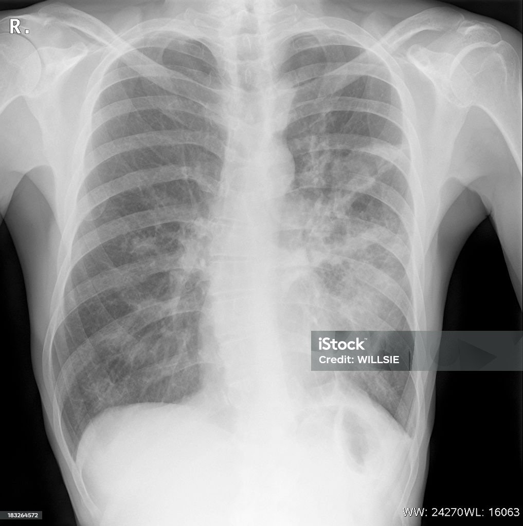 Bem posicionado digital peito xray com uma infecção - Foto de stock de Imagem de raios X royalty-free