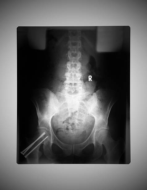 istock Medical X-ray of human hips on a doctors lightbox 183265587