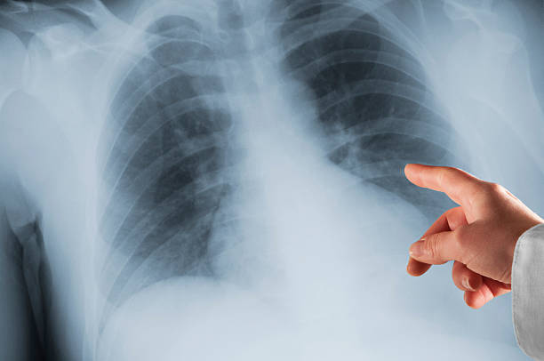 lekarze ręka wskazująca na rtg w zestawie - x ray chest human lung rib cage zdjęcia i obrazy z banku zdjęć
