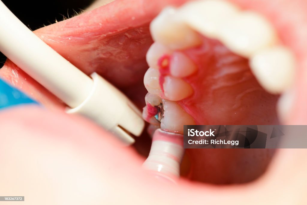 Dentista pulizia Close-up - Foto stock royalty-free di Adulto