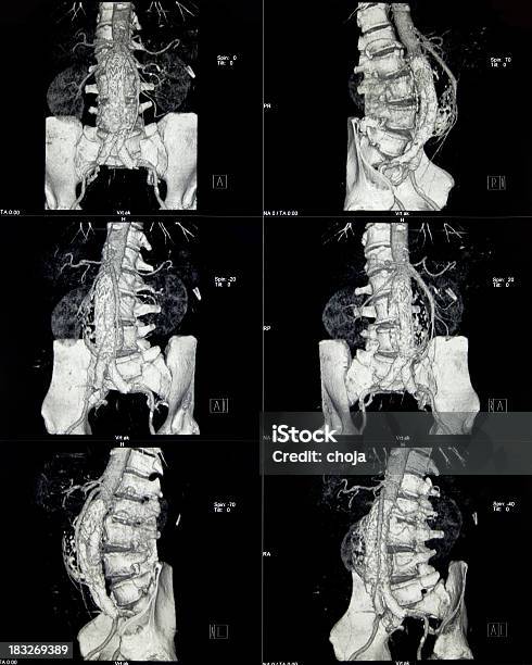 Foto de Tomografia Computadorizada Do Abdômen e mais fotos de stock de Câncer - Tumor - Câncer - Tumor, Abdome, Abdômen Humano