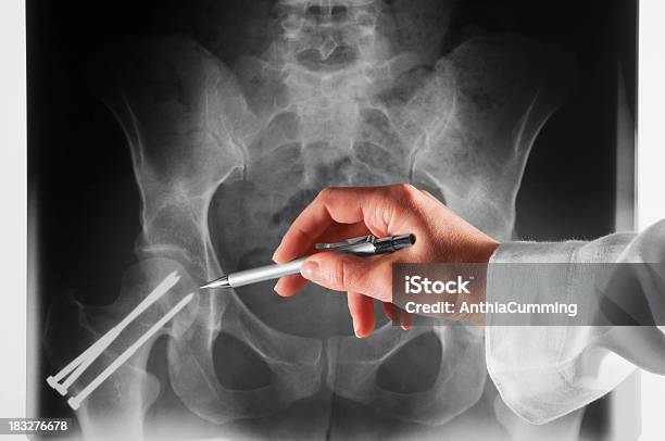 Arzt Punkte Auf Xray Der Hüfte Mit Metallpins Stockfoto und mehr Bilder von Analysieren - Analysieren, Anatomie, Arzt