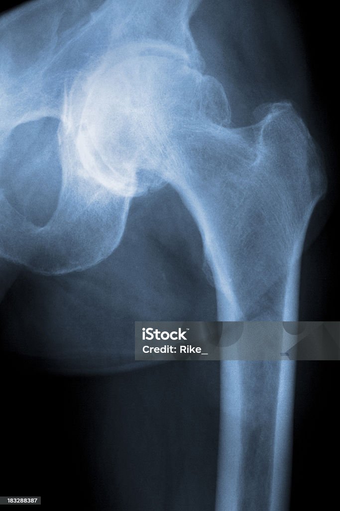 Real Imagem de raios X de um homem moderno com graves Osteoartrite - Foto de stock de Imagem de raios X royalty-free
