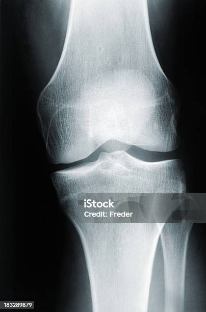 Xray De Una Rodilla Humana Foto de stock y más banco de imágenes de Anatomía - Anatomía, Articulación, Articulación humana