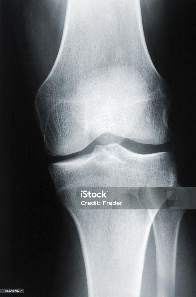 x-ray de um joelho - Foto de stock de Anatomia royalty-free