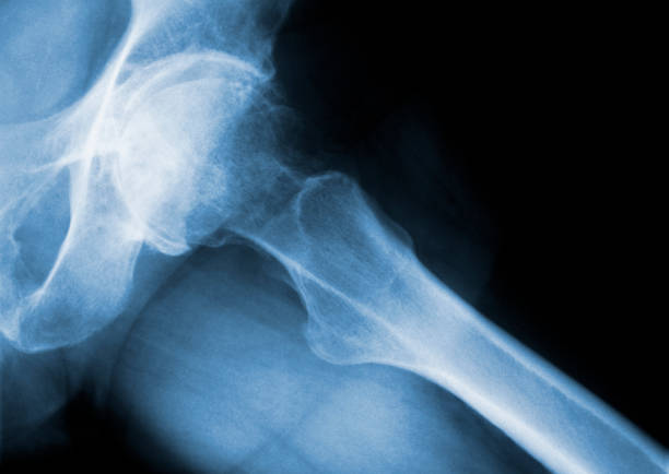istock Real X-ray image of a human hip with severe osteoarthritis 183294200