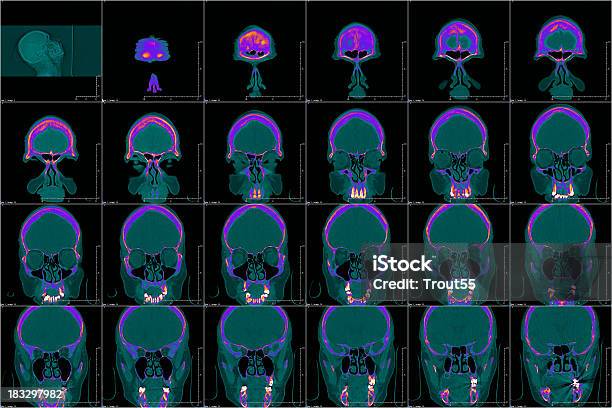 Cabeça Sinusal Em Cor Tac - Fotografias de stock e mais imagens de Cool - Cool, Imagem de raios X, Raio X