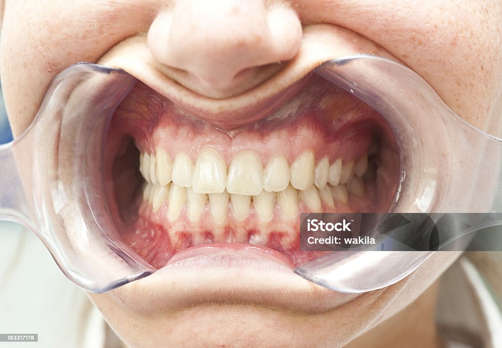 Lippenspreizer Mundspreizer-Ludzkie zęby u dentysty - Zbiór zdjęć royalty-free (Zapalenie dziąseł)