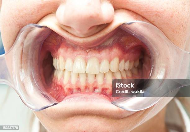Lippenspreizer Mundspreizerludzkie Zęby U Dentysty - zdjęcia stockowe i więcej obrazów Zapalenie dziąseł