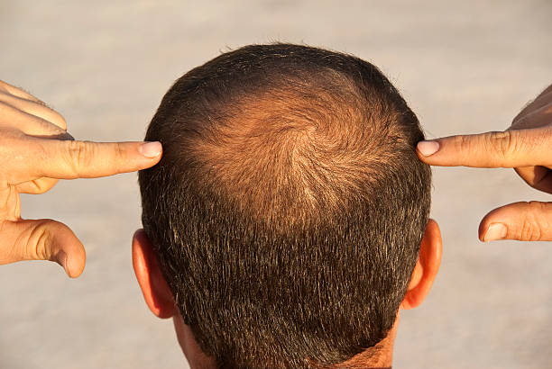 to become bald to become bald completely bald stock pictures, royalty-free photos & images